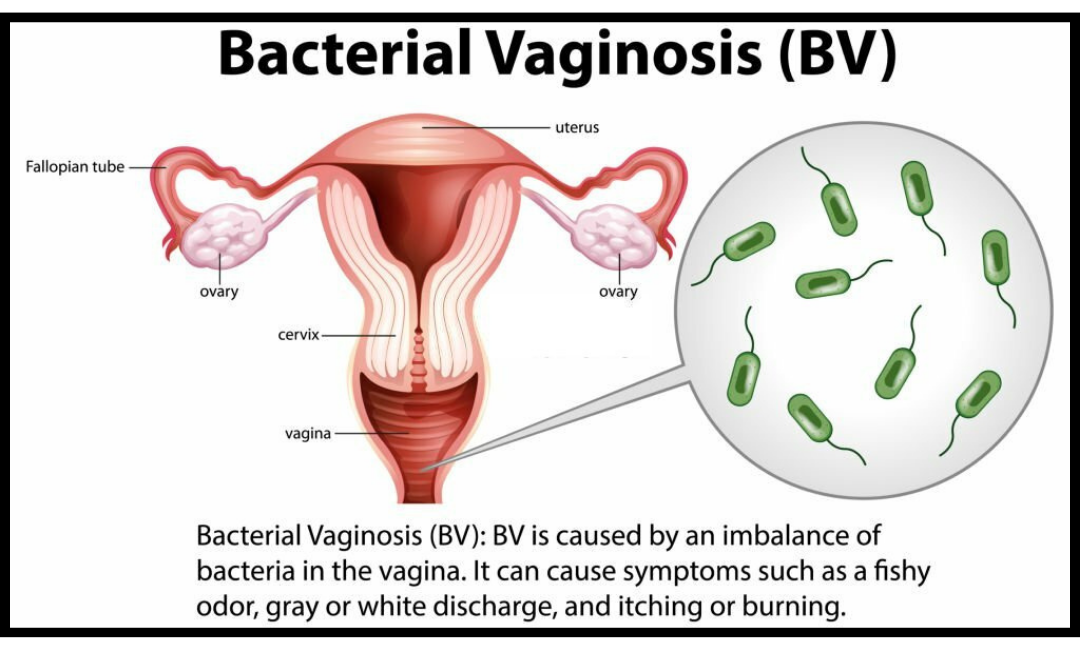 Can Stress Cause BV